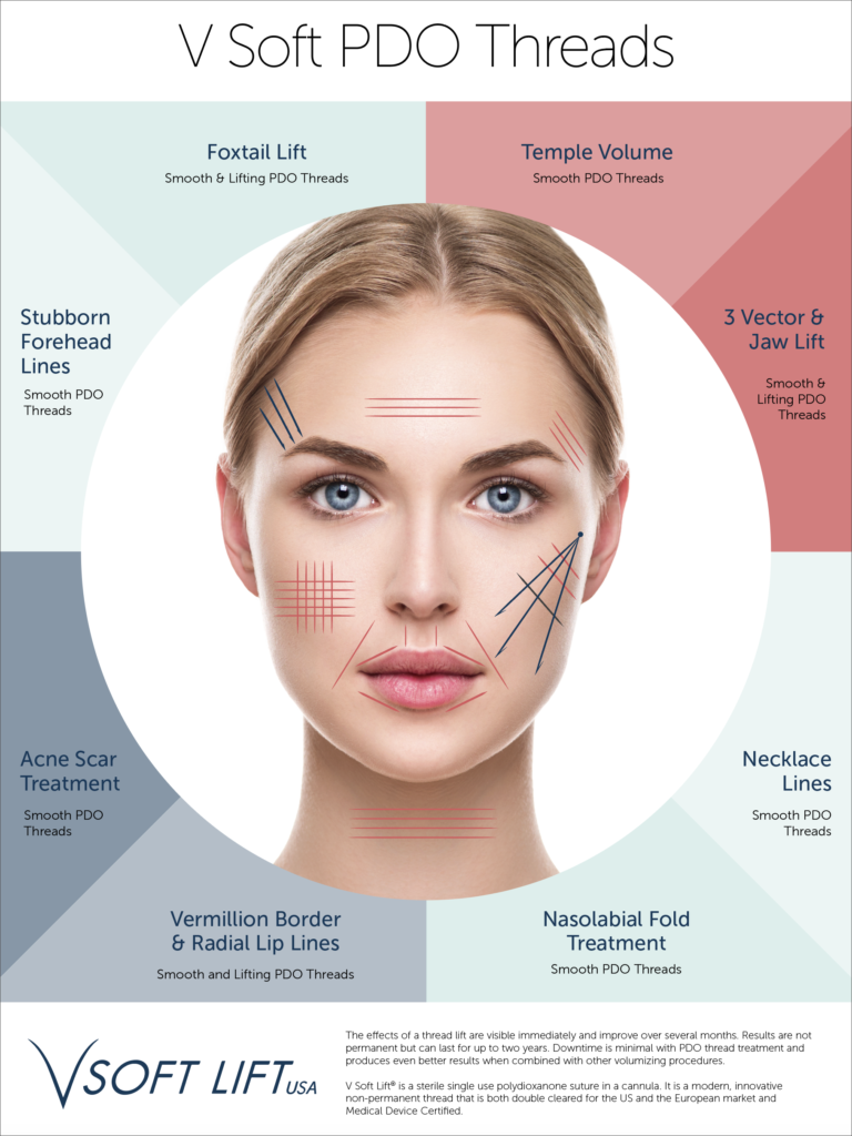 Wheel of Treatment PDO Thread Poster V Soft Lift