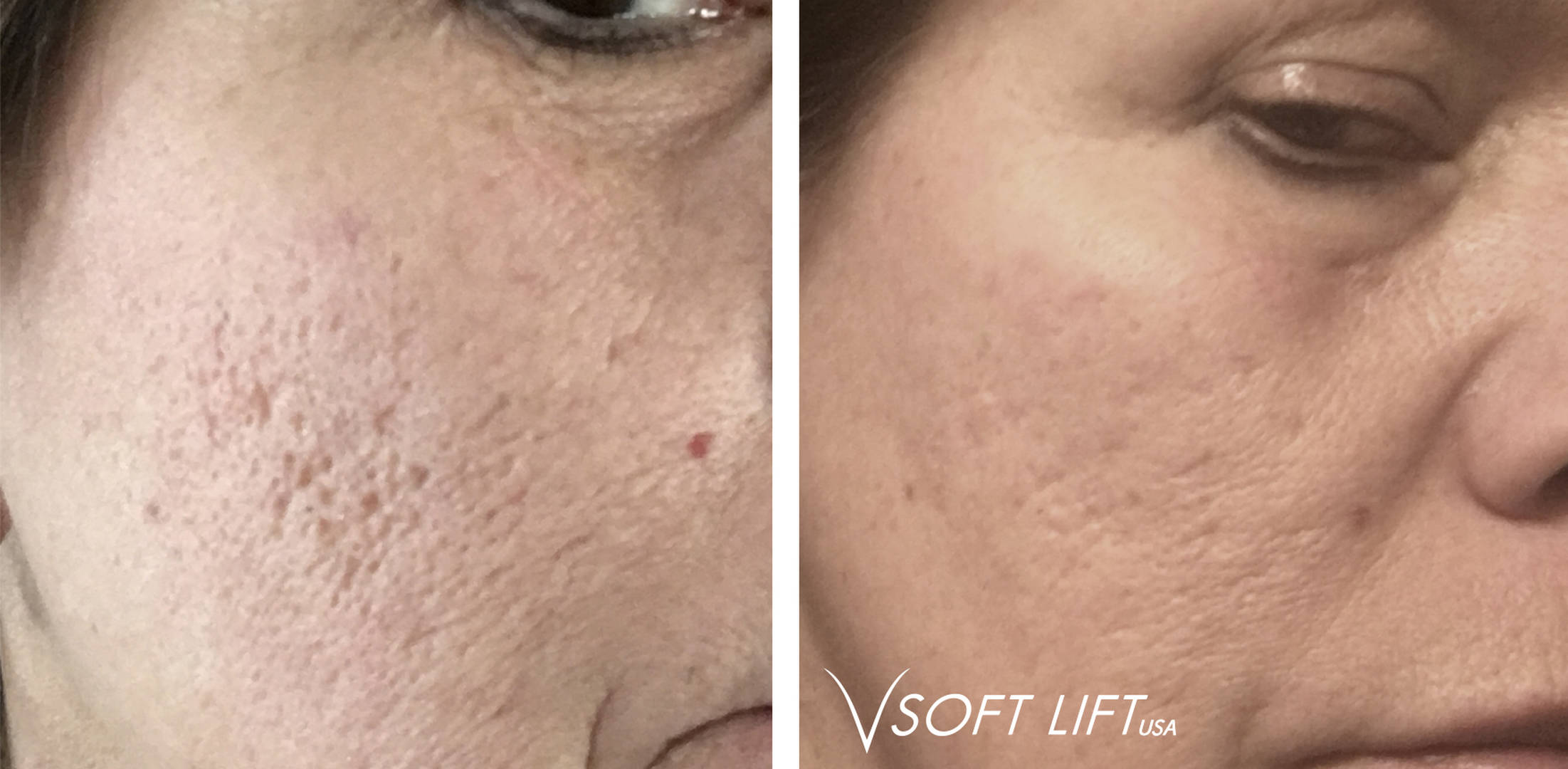 PDO Smooth Threads – Before & After Photos – VSoft Lift Forum